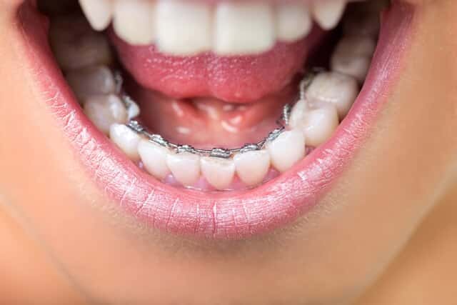 Braces behind teeth are known as “lingual braces” or “Incognito braces” and are similar to traditional metal braces in design. People wanting to straighten their teeth without noticeable braces often go with this option.