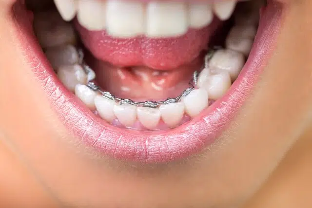 Braces behind the teeth are known as “lingual braces” or 