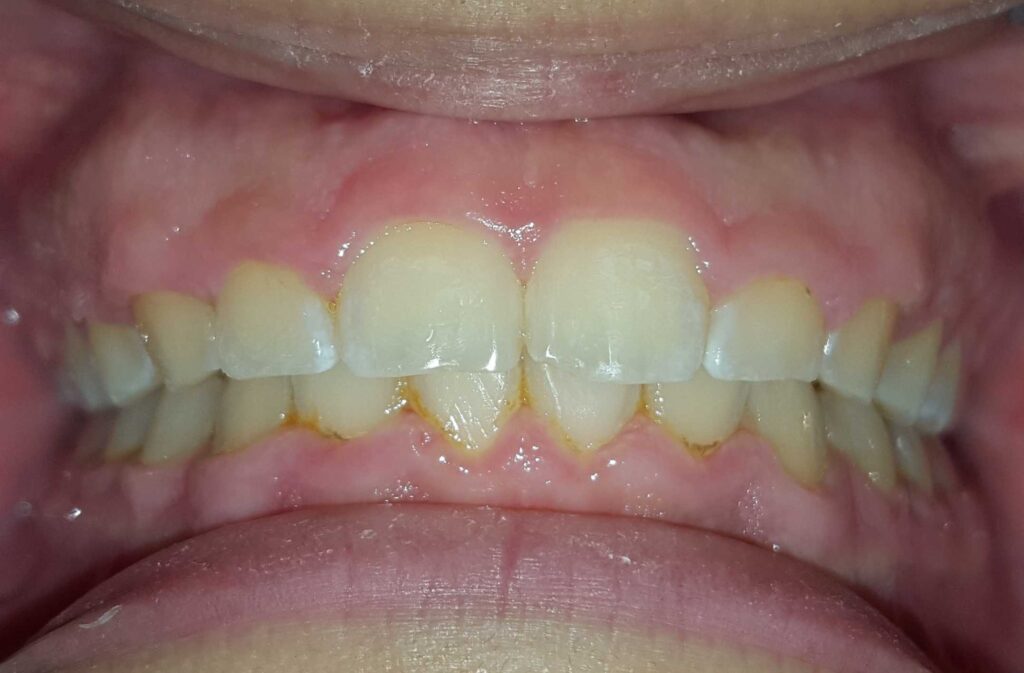 How to Fix an Overbite – Causes, Types & Correction