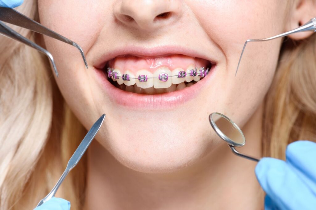 girl with braces during orthodontic treatment