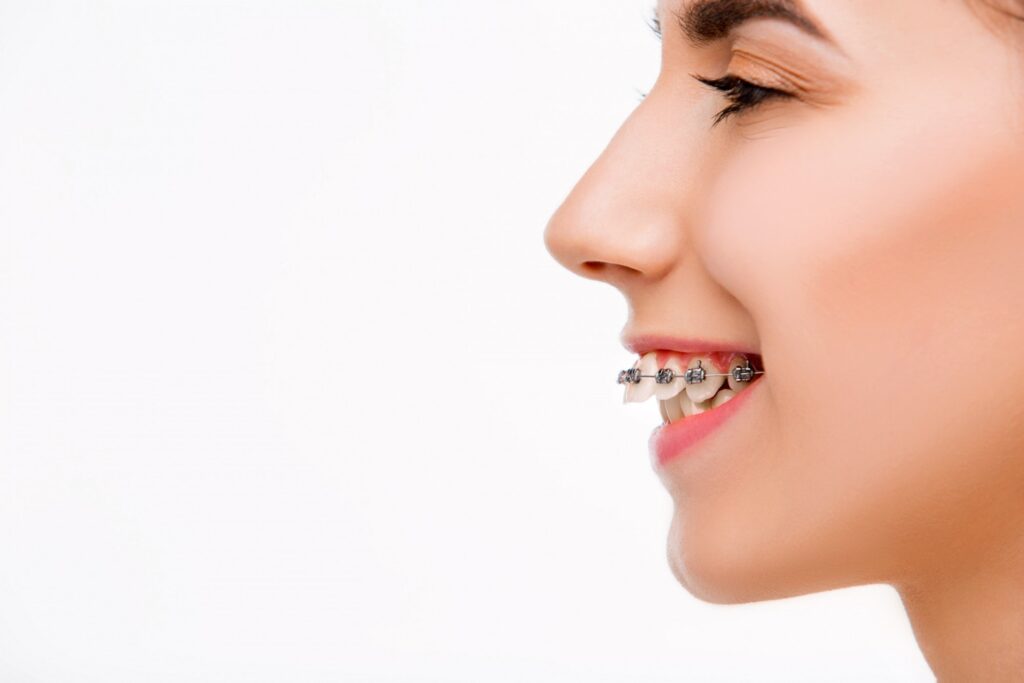 woman with overjet teeth wearing braces