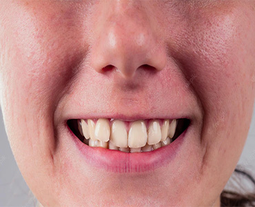 Person with overlapping teeth problem