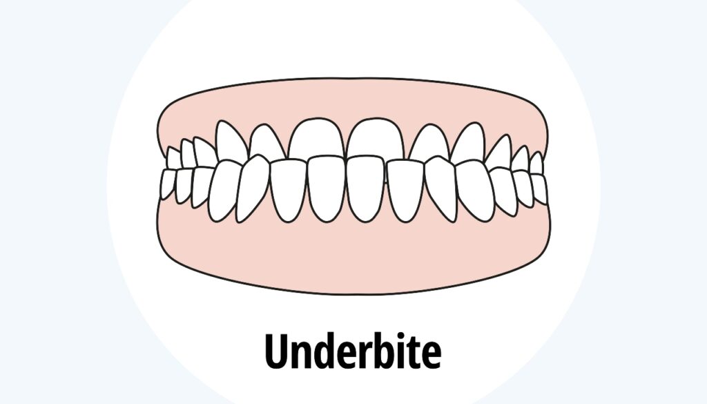 underbite-teeth