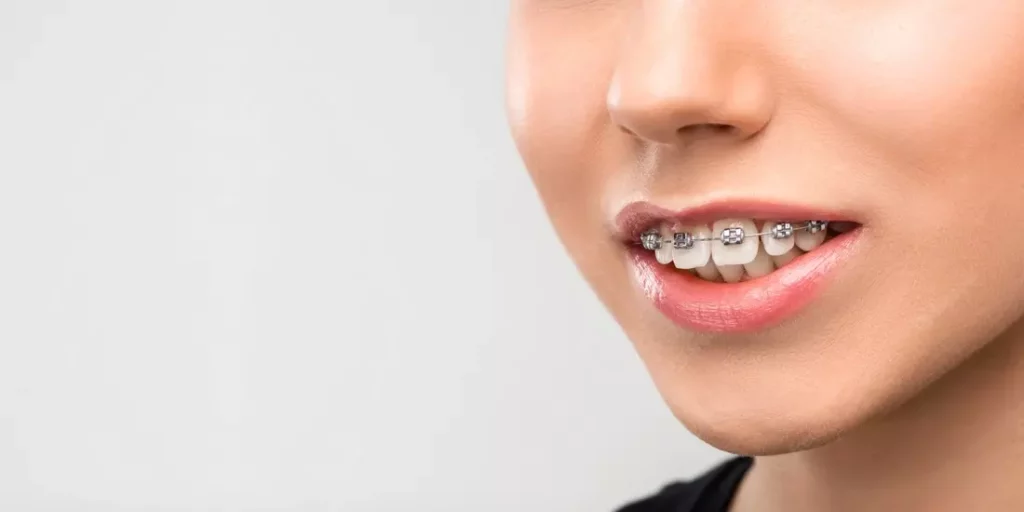 Overbite, also known as malocclusion, is caused when the upper set of teeth does not align with the lower set of teeth because of protrusion. To put it more simply, when the upper set of teeth overlaps the lower one,.