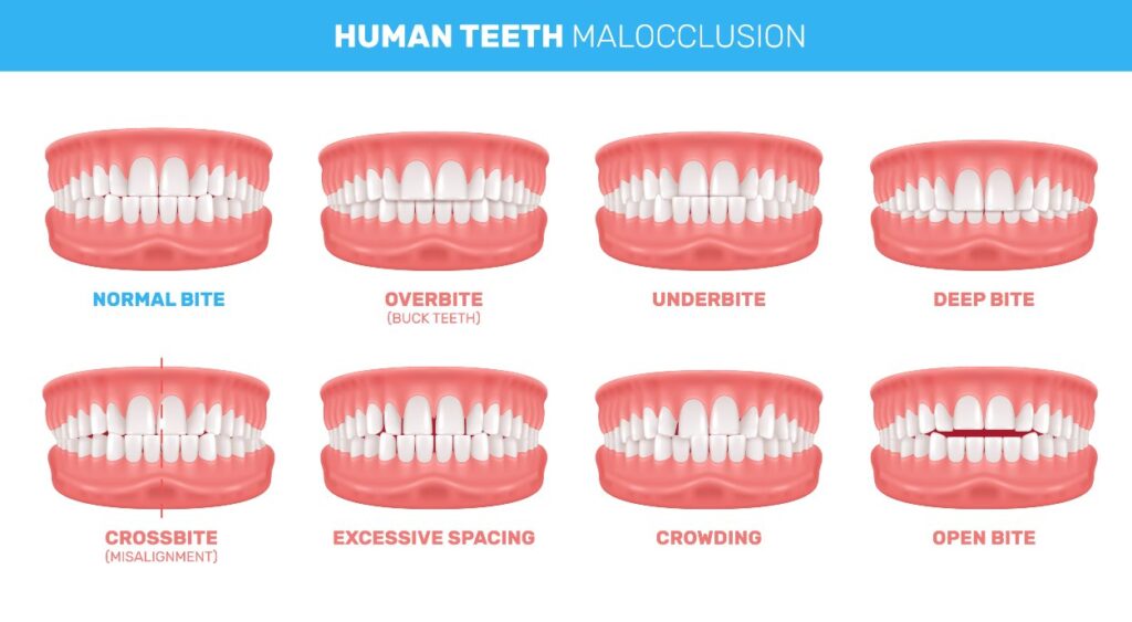 human-teeth-malocclusion