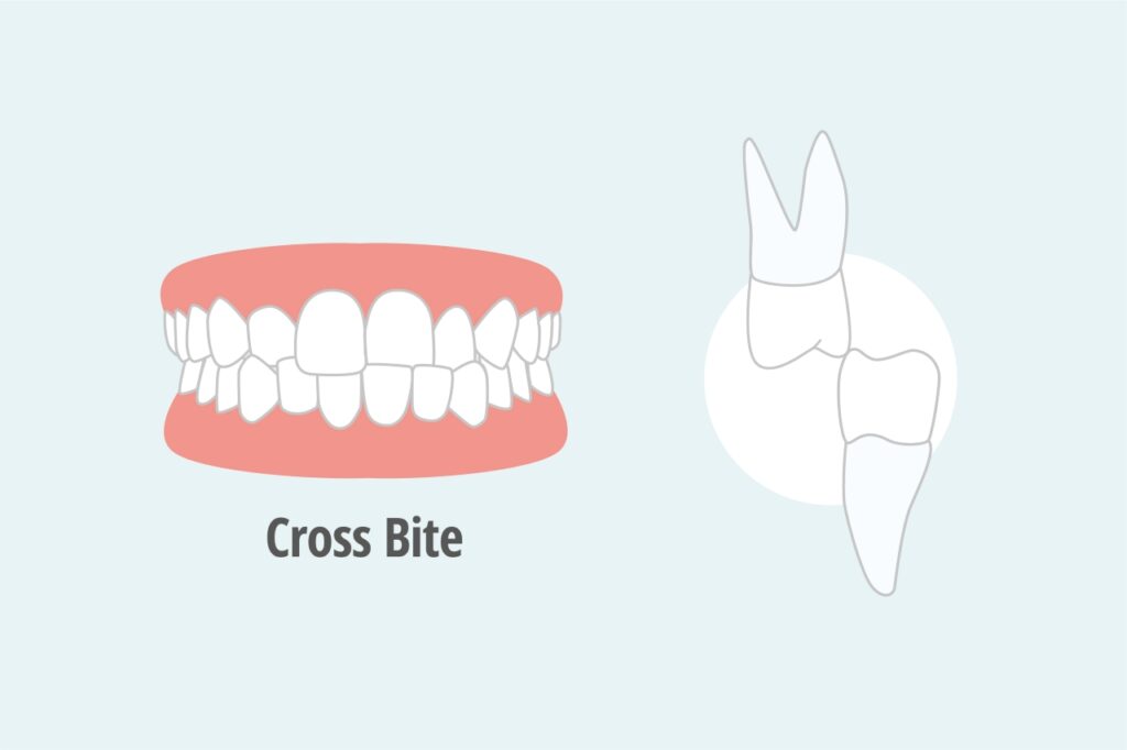 crossbite teeth