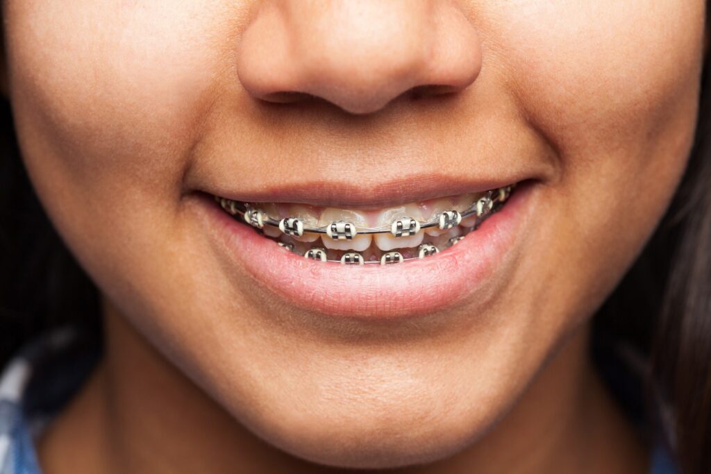 Bite blocks are dental devices made of plastic or rubber that create space between upper and lower teeth. They're used in orthodontics to correct bite issues like overbites or underbites by guiding teeth into the right position.