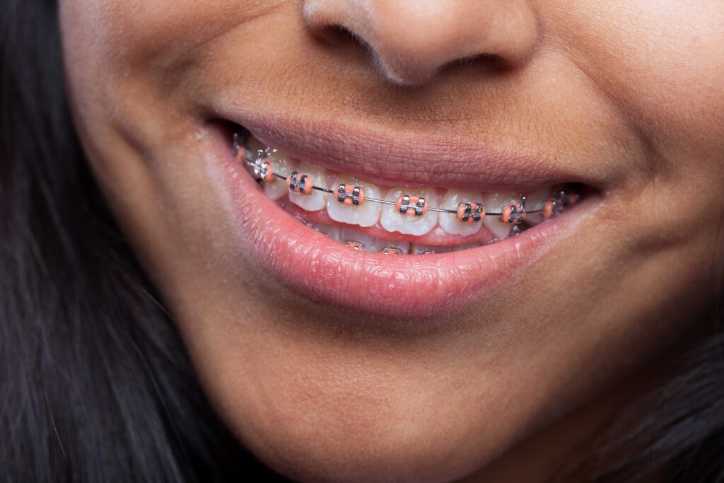spacers for braces