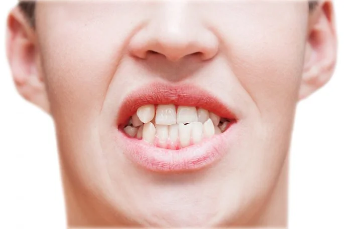 woman-showing-her-misaligned-crooked-teeth