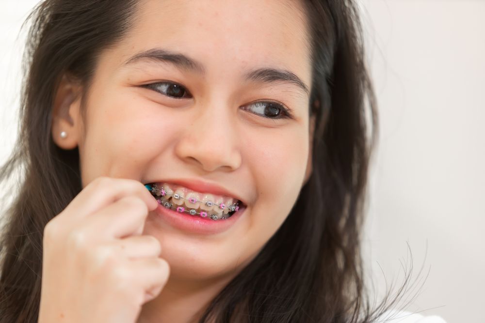 Braces Fix a Crossbite