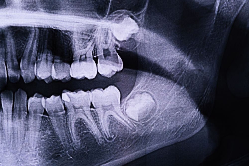 What Are Impacted Wisdom Teeth
